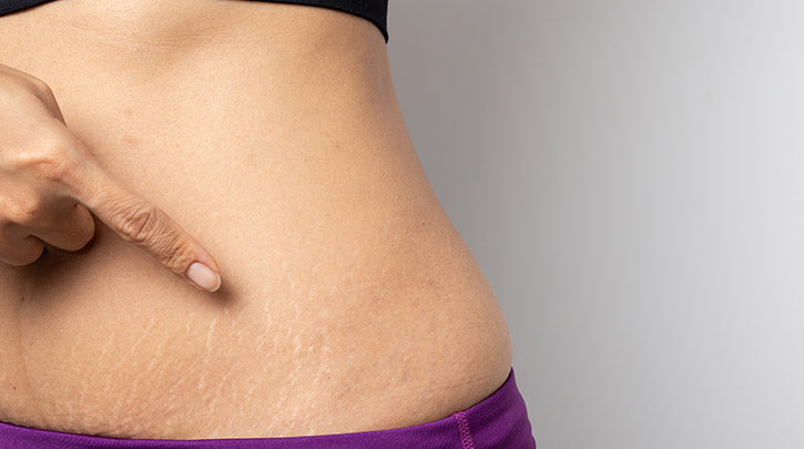 The Magic of Concealment: Hiding Stretch Marks Seamlessly